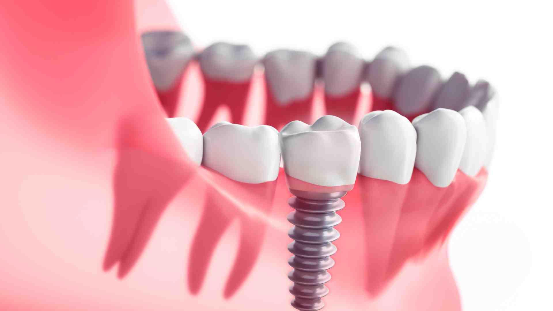 Caring for Your Dental Implants