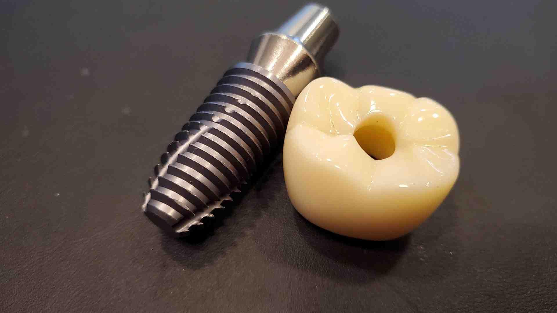 So, How Do Dental Implants Improve Your Smile