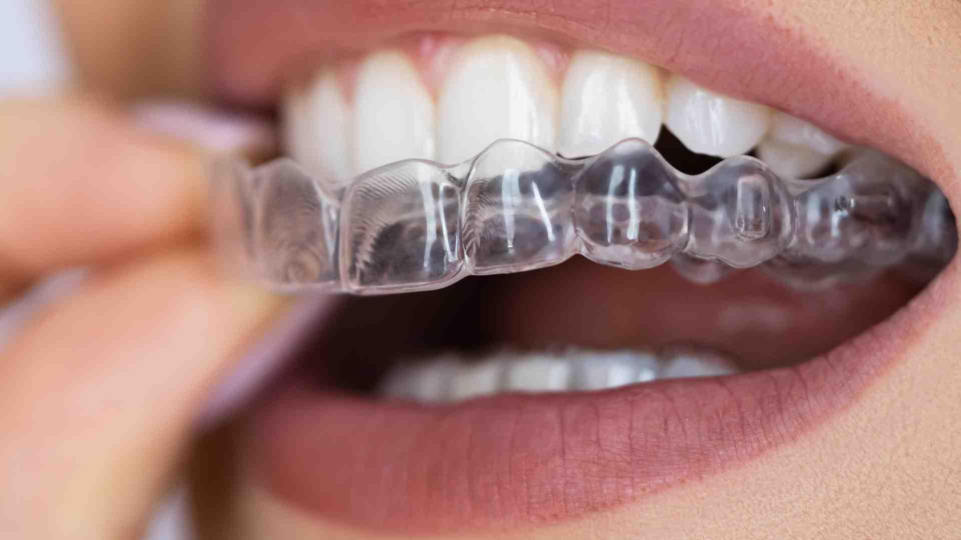 What Happens If You Don't Wear Invisalign Enough