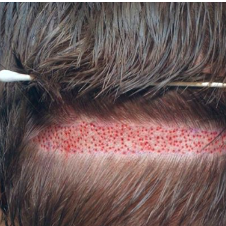 Hair Transplant In Pakistan